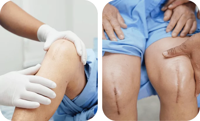 Co to jest endoproteza kolana i dlaczego rehabilitacja jest tak ważna?